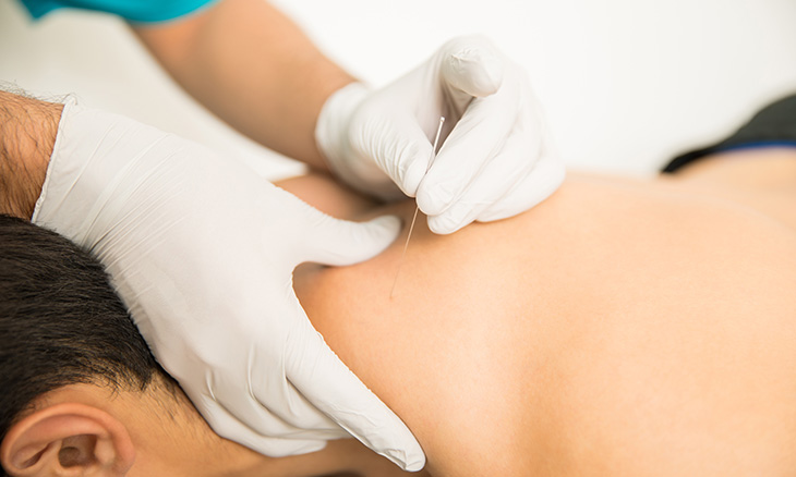 Dry needling offered in Bayhealth Outpatient Therapy