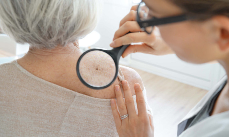 Bayhealth skin screening for skin cancer